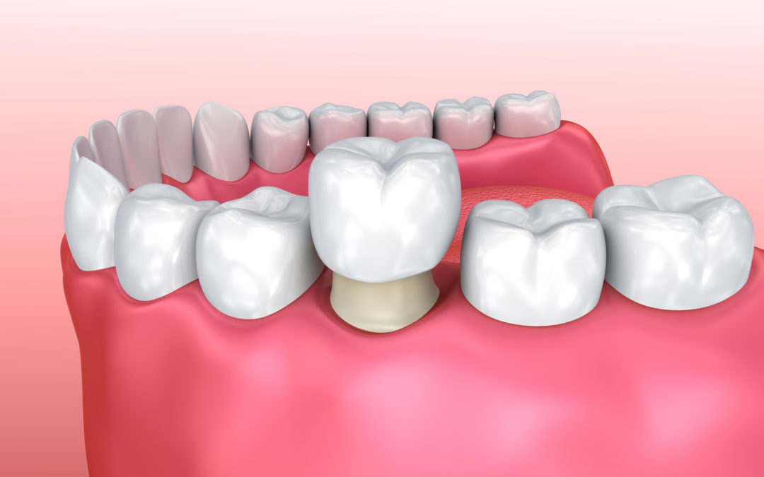 dental-crowns-1080x675 dental-crowns-1080x675